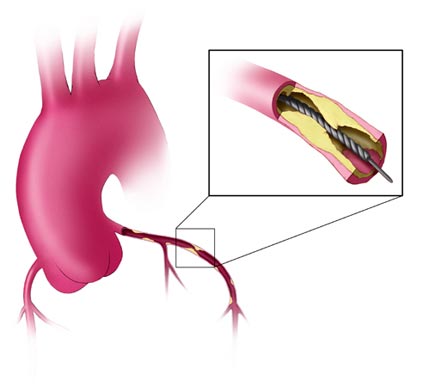Percutaneous Transluminal Angioplasty with Stent Monmouth Cardiology Associates