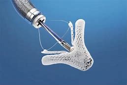 MitraClip Procedure- Non-Surgical Solution for Mitral Valve Regurgitation Monmouth Cardiology Associates