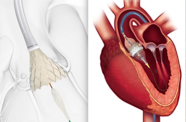 FDA Approves TAVR for Low-risk Patients Creates A Paradigm Shift in Cardiology Monmouth Cardiology Associates