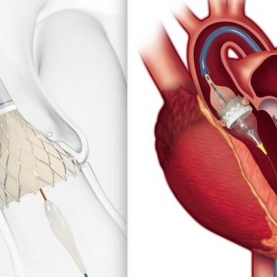 Houston Methodist Willowbrook now offers minimally invasive TAVR procedure,  providing faster recovery for patients with heart valve disease