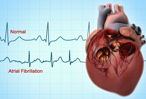 Do you have Atrial Fibrillation?  Monmouth Cardiology Associates