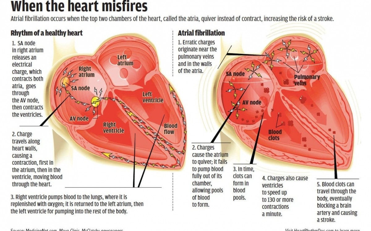 September is Atrial Fibrillation Awareness Month  Monmouth Cardiology Associates
