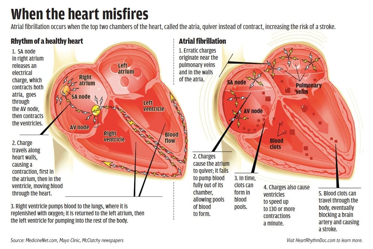 September is Atrial Fibrillation Awareness Month  Monmouth Cardiology Associates